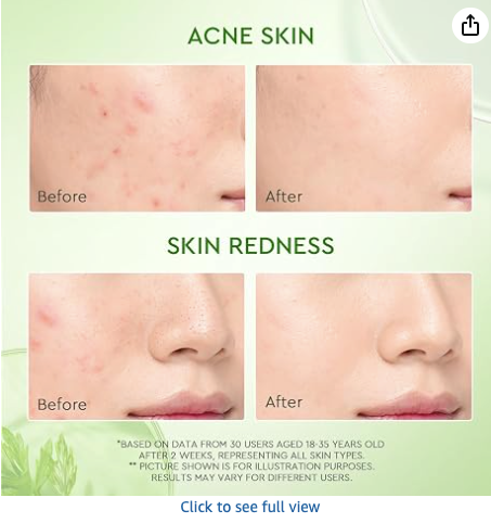 Before and after results — acne skin and skin redness